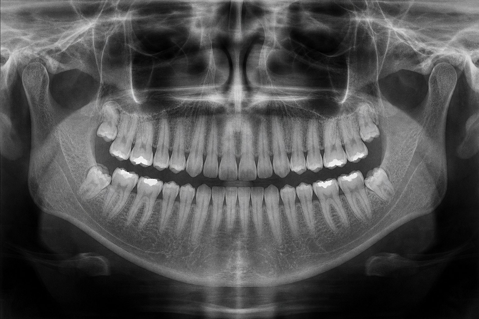 A panoramic dental X-ray of an adult mouth with four findings marked: an impacted wisdom tooth, decay between two molars, a failing old filling, and early bone loss along the lower jaw.